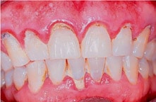 PERIODONTAL DISEASE after