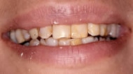 Cosmetic Dentistry Before