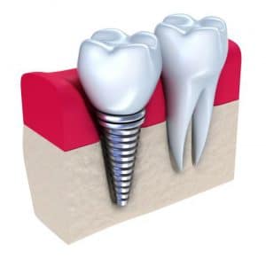 Dental Implant Ameria Dental