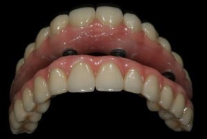 Dental implant Replace Dentures