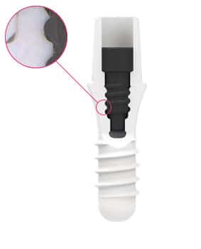 zeramex screw retained 2 piece zirconia implant