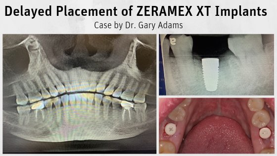 Delayed Placement of ZERAMEX-XT Implants by Dr. Gary Adams