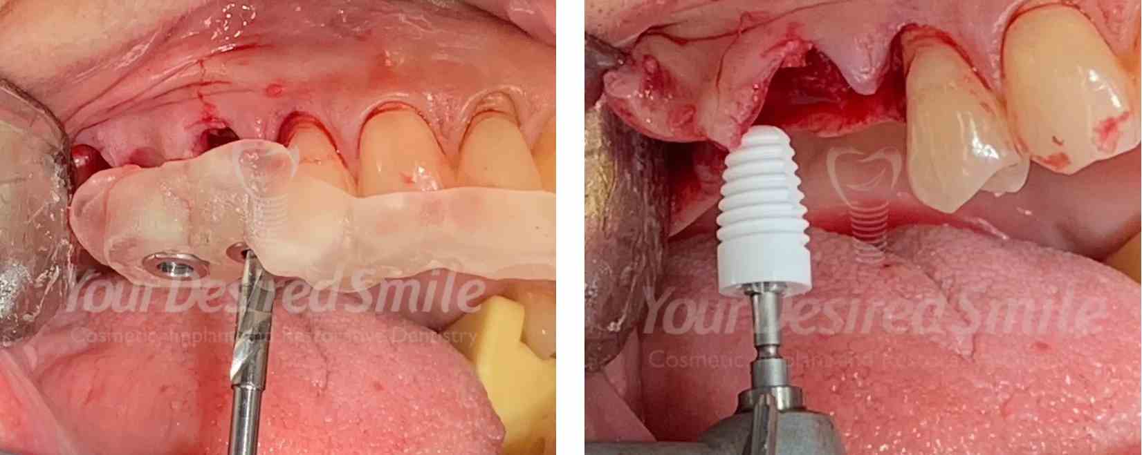 Posterior Zirconia Implants Guided Surgery Zeramex USA