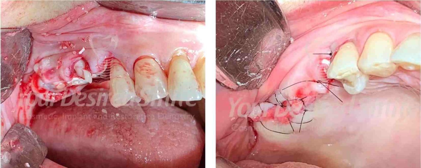 Posterior Zirconia Implants Guided Surgery