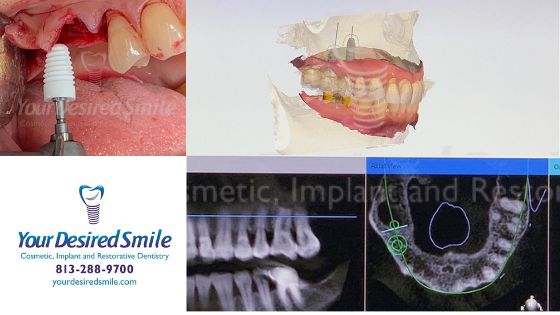 Posterior Zirconia Implants Guided Surgery