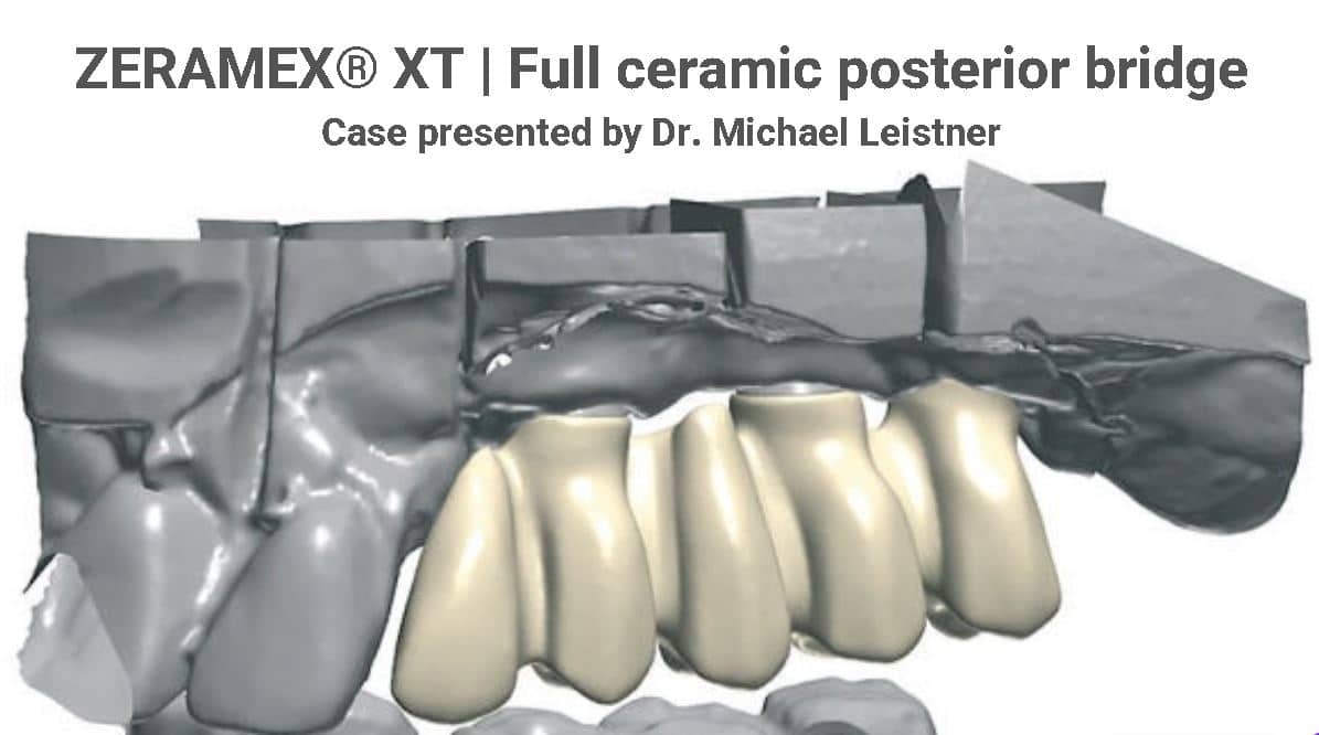 ZERAMEX® XT Full ceramic posterior bridge