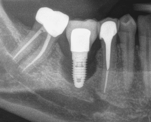Increased Levels of Dissolved Titanium Are Associated With Peri-Implantitis - A Cross-Sectional Study.