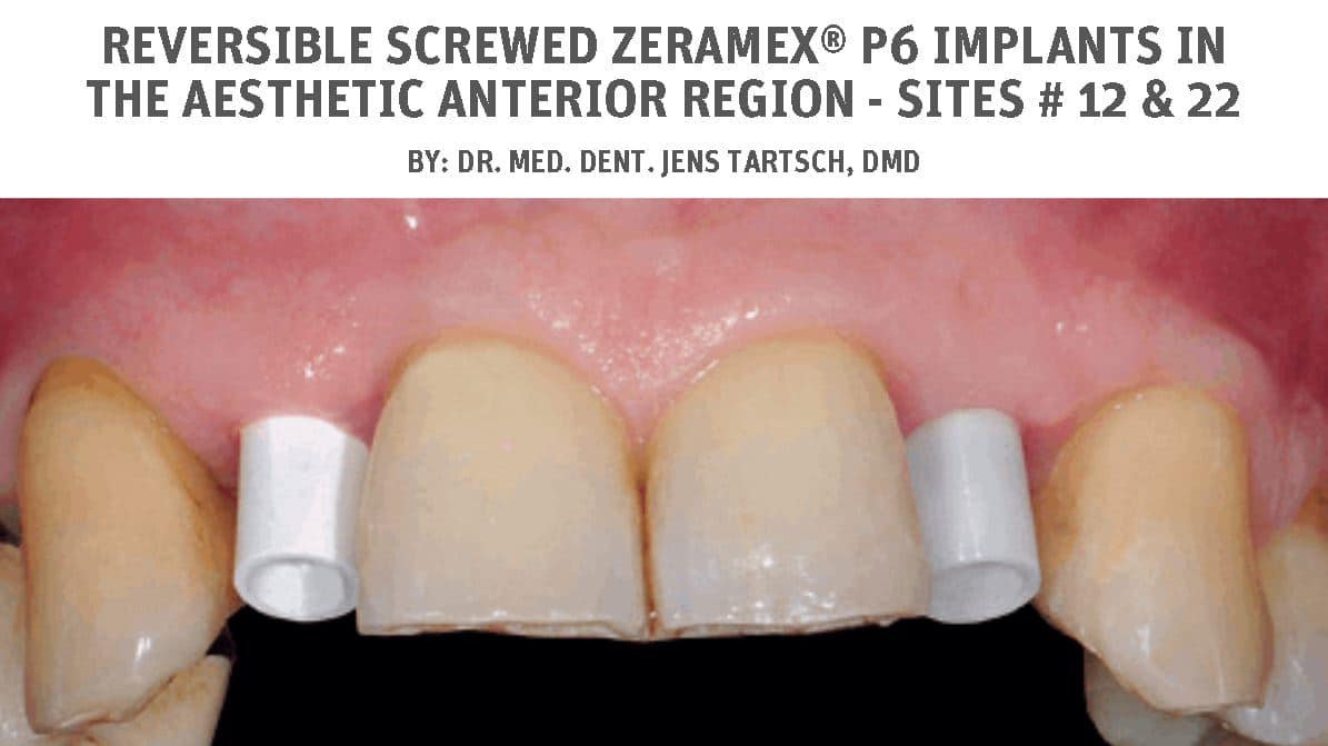 Reversible screwed ZERAMEX® P6 implants