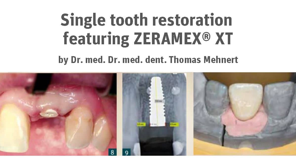 Single tooth restoration with one All-Ceramic Implant Solution in the anterior region