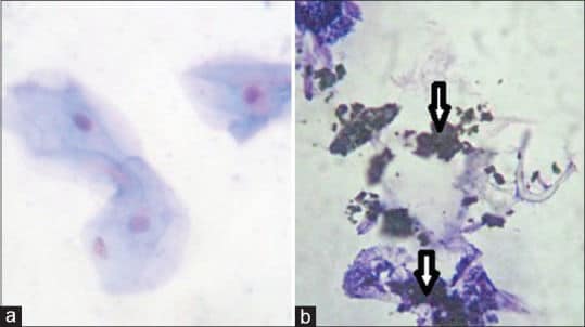 Titanium particles in tissues from peri-implant mucositis