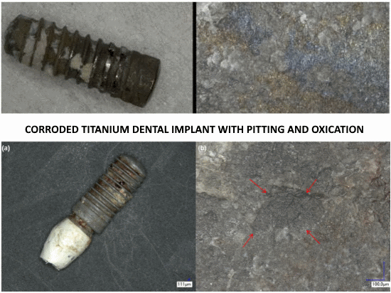 Titanium release in peri-implantitis