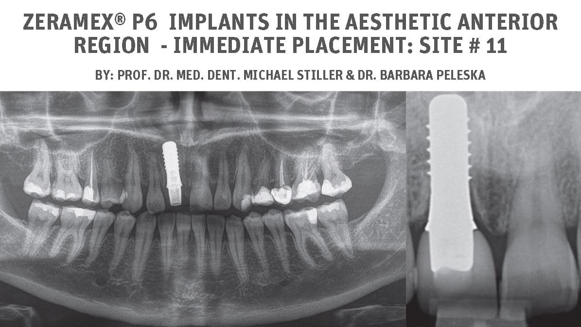 ZERAMEX® P6 implants in the aesthetic anterior region