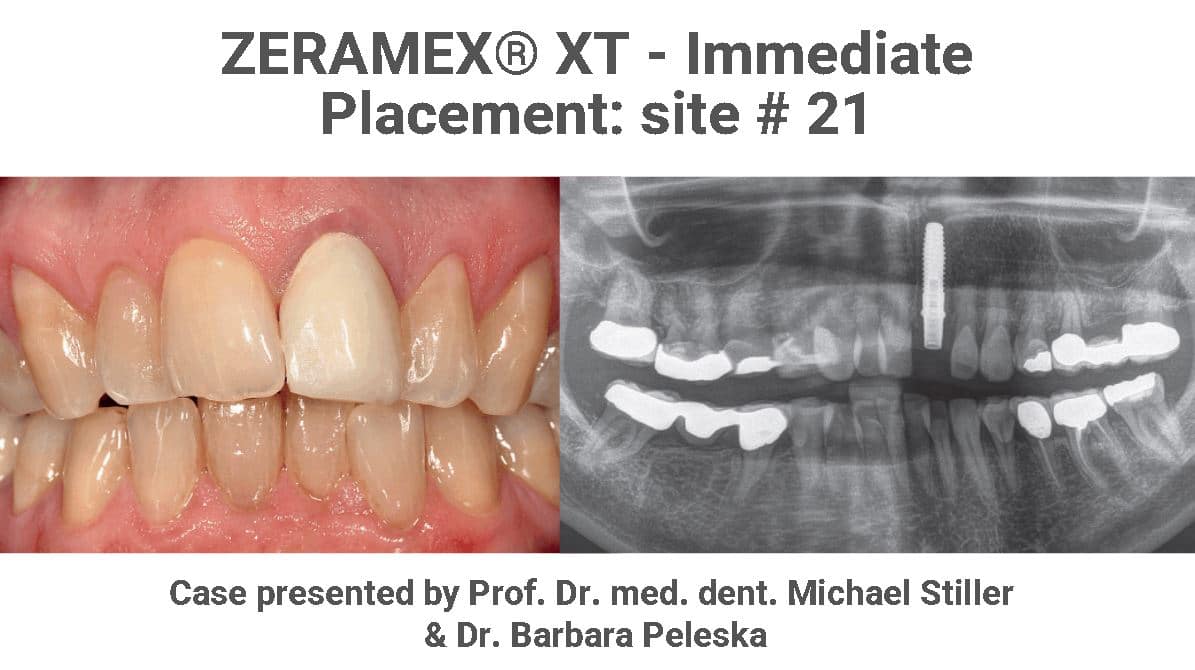 ZERAMEX® XT - Immediate Placement site 21
