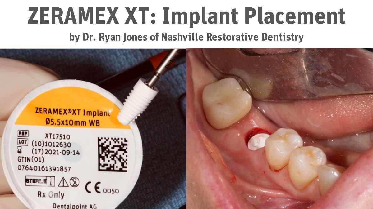 ZERAMEX® XT Implant Placement by Dr. Ryan Jones of Nashville Restorative Dentistry