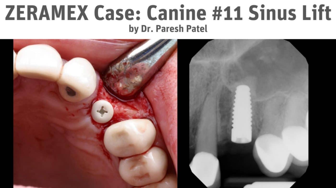 ZERAMEX Implant Test Case by Dr. Paresh Patel