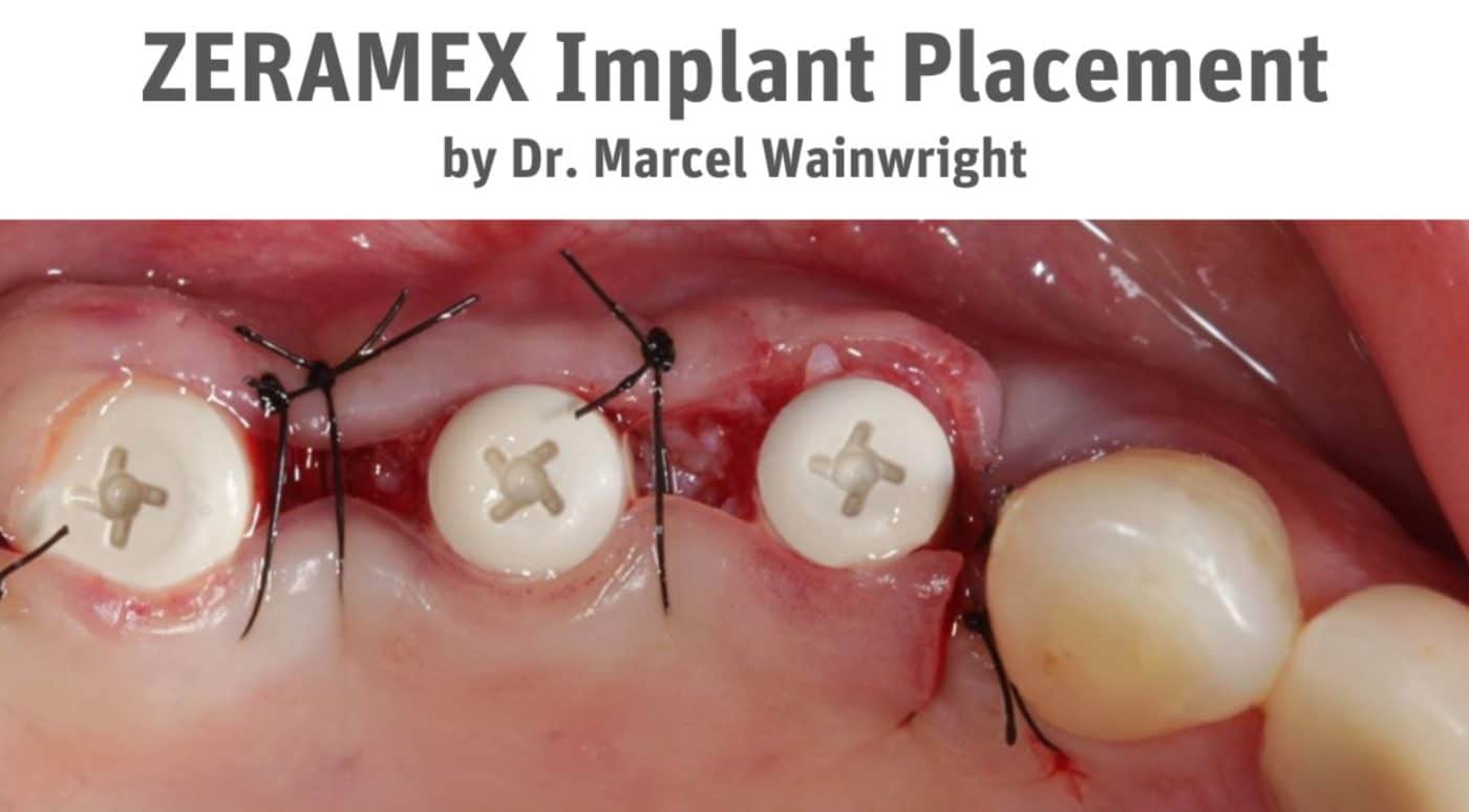 ZERAMEX XT Implant Placement by Dr. Marcel Wainwright