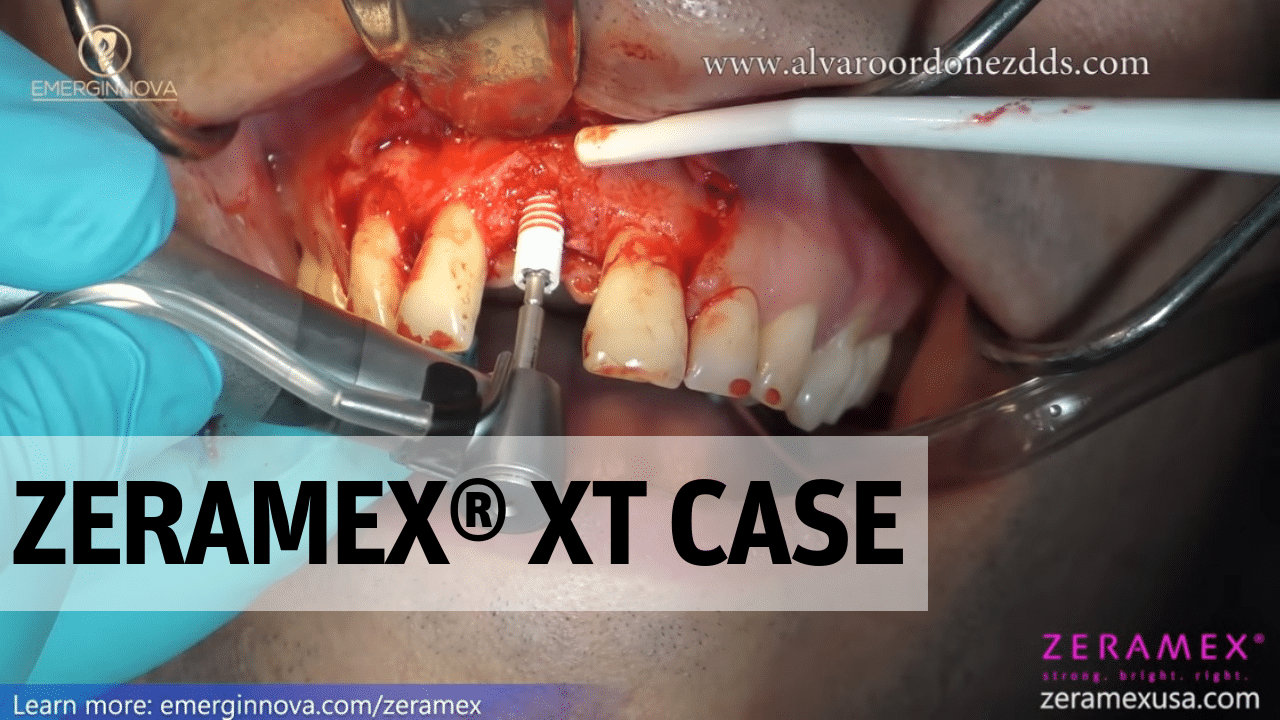 ZERAMEX® XT Tapered Ceramic Implant placed in Narrow Ridge