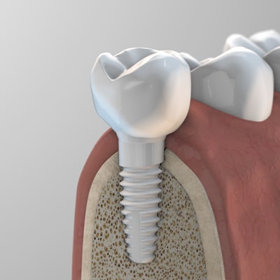 zeramex_xt_monolithic_crown_400x400px