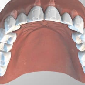 zeramex_xt_solution_upper_400x400px