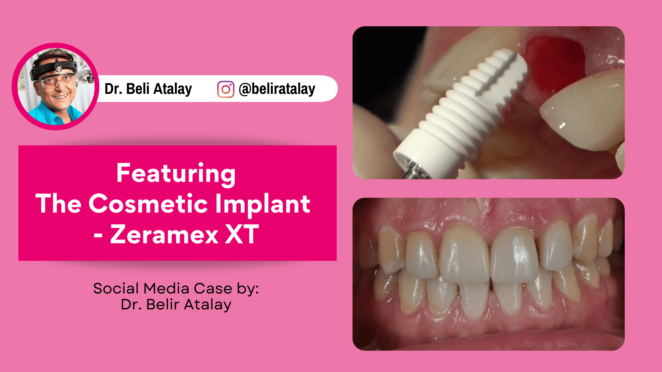 Zeramex XT: The Cosmetic Implant - #PremiumImplantology - Zeramex USA