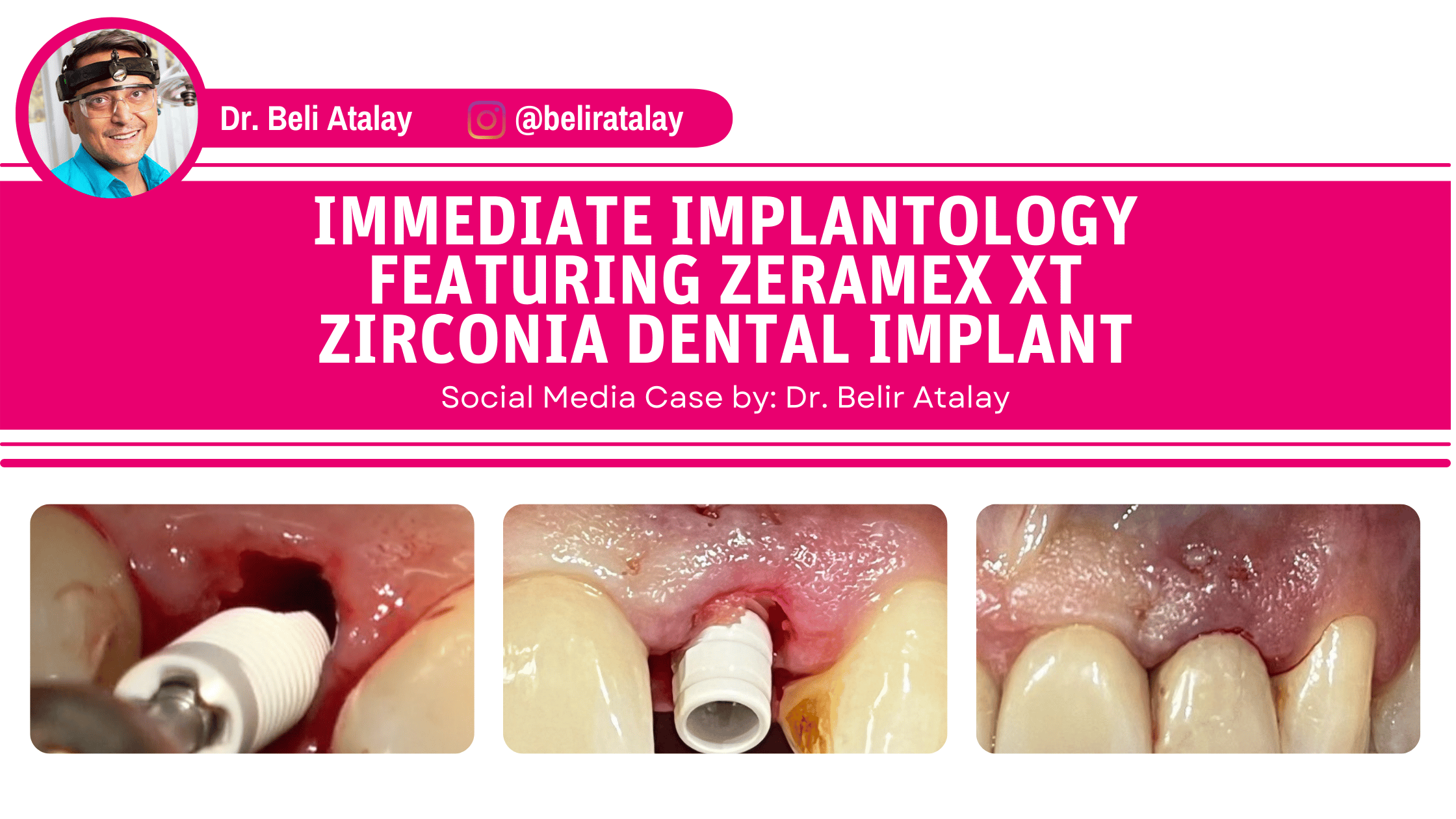 PremiumImplantology ZERAMEX XT Zirconia Dental Implant Zeramex USA