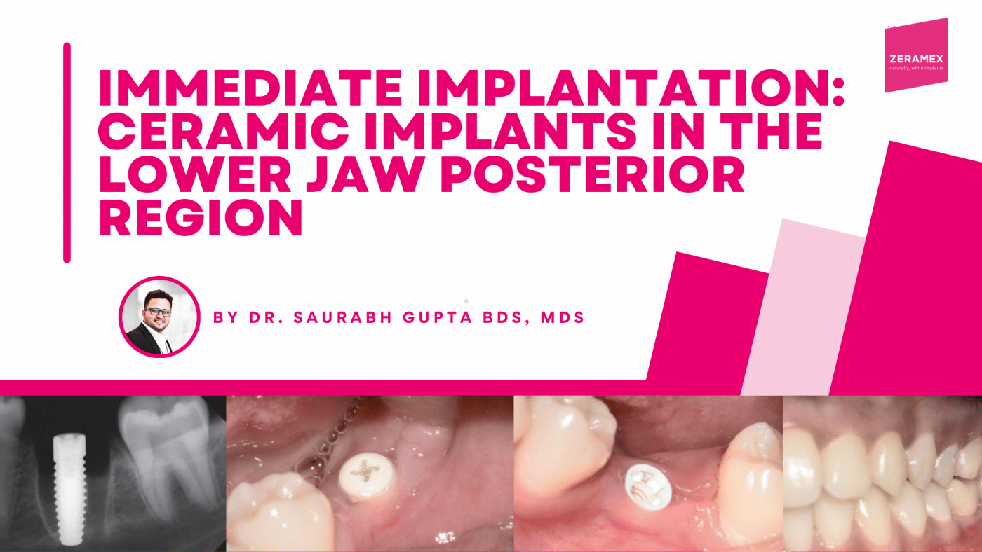 Immediate implantation by dr Saurabh Gupta