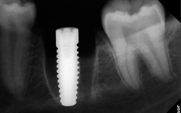 Fig 4d: X-ray image of the implant region 36