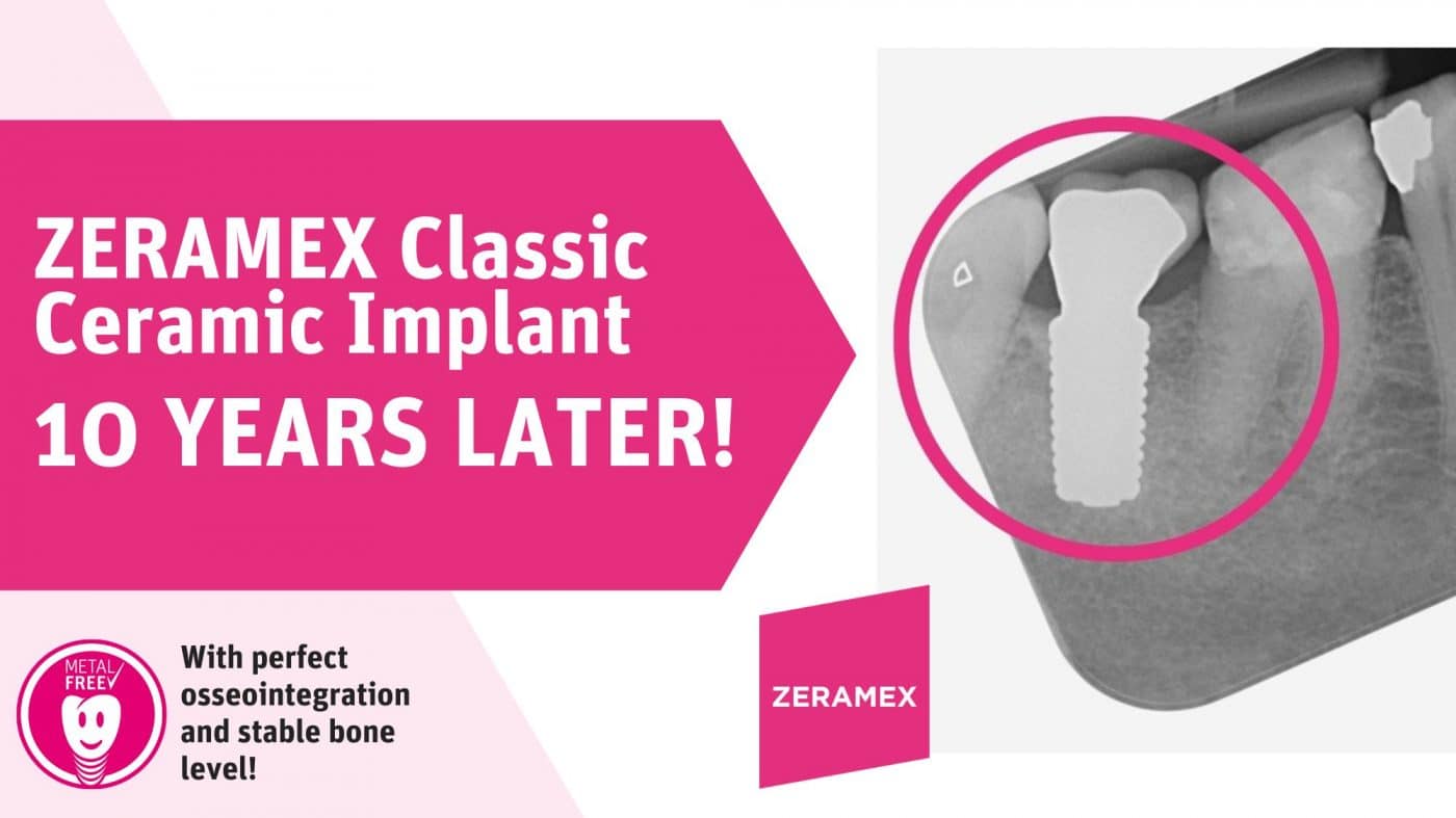 How Long Should My ZIRCONIA BioCeramic Dental Implant last? Zeramex USA