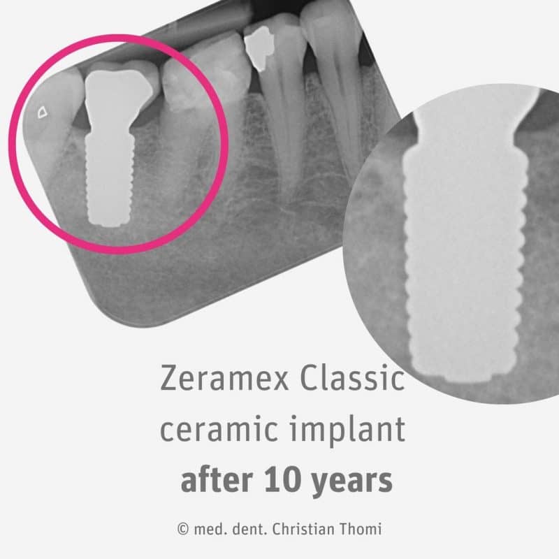 zeramexusa_ZERAMEX Classic Ceramic Implant_10 years later_2