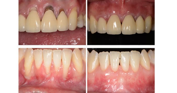 Master Soft Tissue Management: Join Dr. Anton Sculean and Dr. Richard Miron for an In-depth Course on Improving the Predictability of Regenerative and Plastic Esthetics Periodontal Surgery + Peri-Implant Surgery