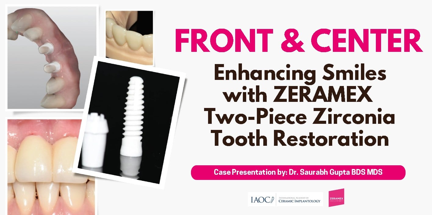 Front and Center: Enhancing Smiles with ZERAMEX Two-Piece Zirconia Tooth  Restoration - Zeramex USA